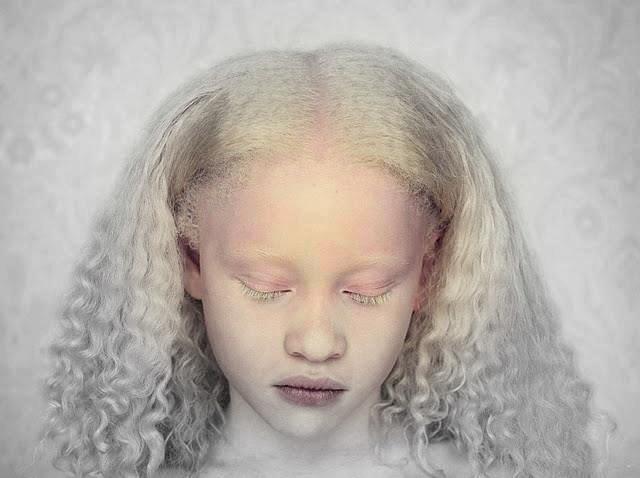 Albinizam, mitovi i činjenice