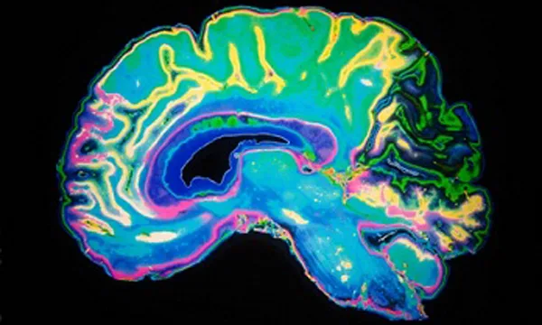Studija otkriva mogući uzrok Alchajmerove bolesti