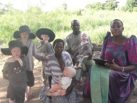 Albinizam u Africi